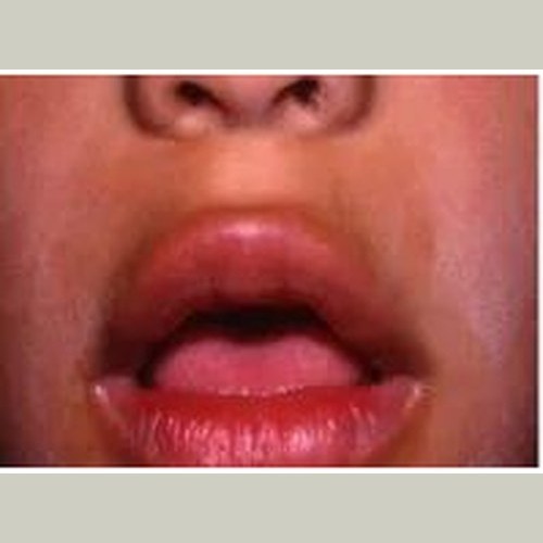 Close-up photograph of a person breathing through an open mouth — lips parted, demonstrating habitual mouth-breathing posture.