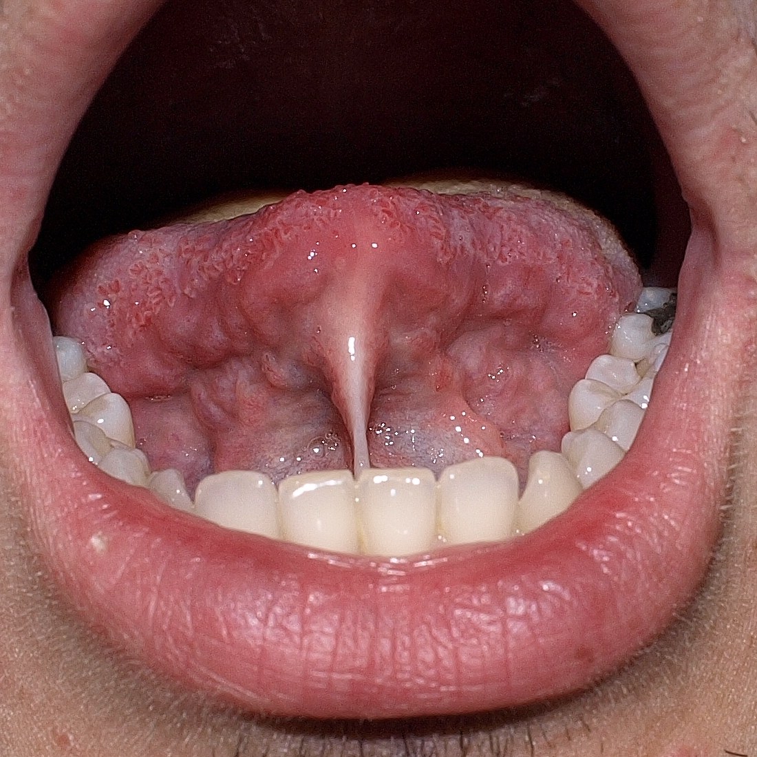 Clinical photograph of an adult tongue-tie (ankyloglossia) showing restricted frenum attachment.